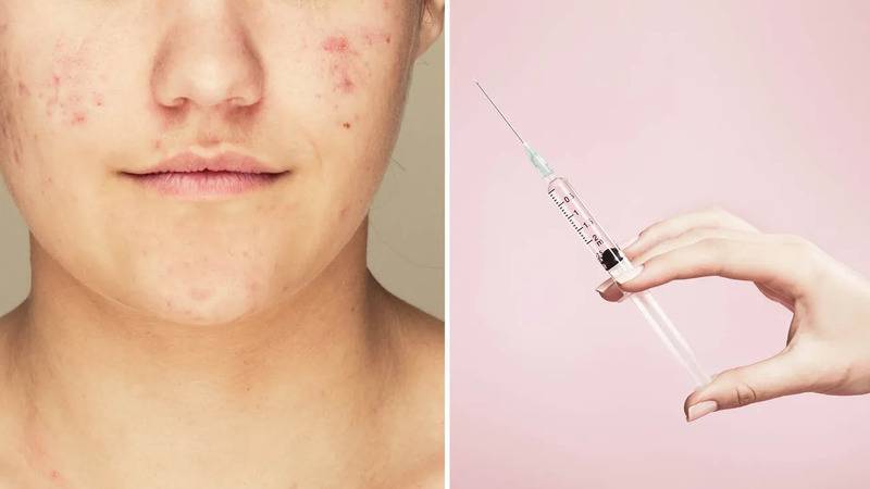 sivilceye karsi iki asi gelistiriliyor mrna denemesi ve enzim hedefli yaklasim R5mKCv8v